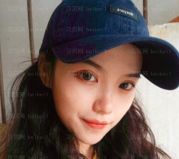 广州市荔湾区人民医院整形美容科,常辉彦,双眼皮介绍,一双漂亮的眼睛晴很为颜值加分