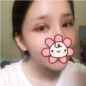 广州市荔湾区人民医院整形美容科,齐云香全切双眼皮介绍,的确是可以节省不少时间~总之是很满意的哦！