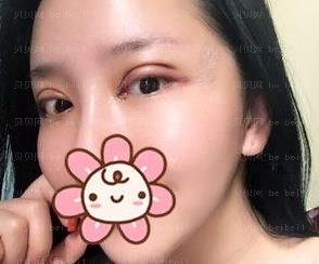 广州市荔湾区人民医院整形美容科,齐云香全切双眼皮介绍,的确是可以节省不少时间~总之是很满意的哦！