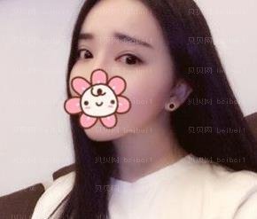 广州市荔湾区人民医院整形美容科,齐云香全切双眼皮介绍,的确是可以节省不少时间~总之是很满意的哦！