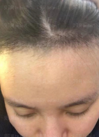 广州市荔湾区人民医院整形美容科,齐云香植发际线介绍