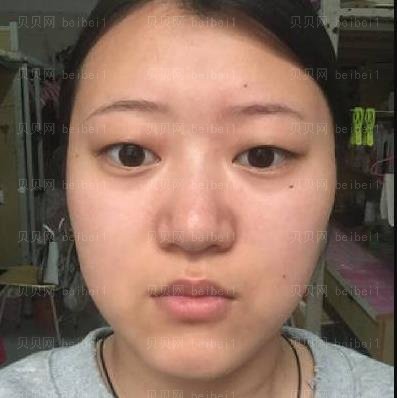 广州市荔湾区人民医院整形美容科,齐云香埋线双眼皮介绍,比我想象的要好看，真的是太满足了