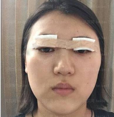 广州市荔湾区人民医院整形美容科,齐云香埋线双眼皮介绍,比我想象的要好看，真的是太满足了