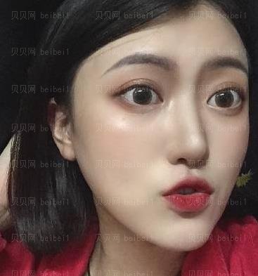 广州市荔湾区人民医院整形美容科,齐云香埋线双眼皮介绍,比我想象的要好看，真的是太满足了