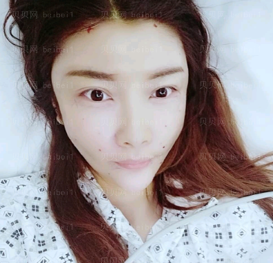 广州韩妃医学美容医院 于洪瑞医生 自体脂肪面部填充介绍分享