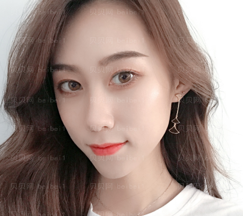 广州韩妃医学美容医院 周国伟医生 眼部多项:双眼皮+去皮去脂+上睑下垂矫正介绍分享