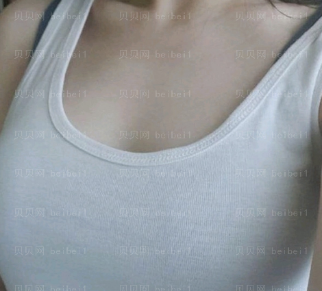 广州韩国瓷肌医疗美容门诊部 胡春光医生 自体脂肪隆胸介绍片分享