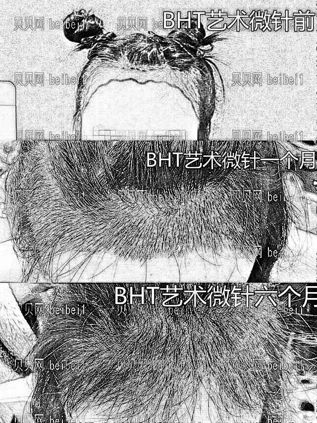 植发前后体验全过程分享·考虑了半年还是去把发际线给种了