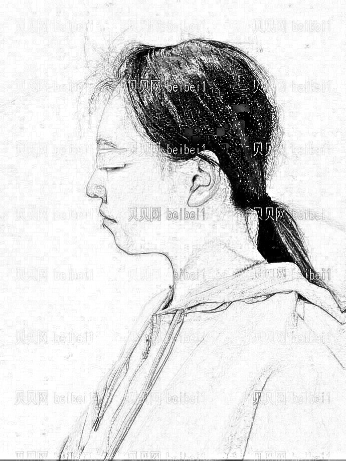 【双眼皮术后1天】天生单眼皮的我，看起来总是给人一种不够精神的感觉，好显老。