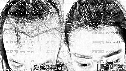 郑州东雅微针植发大概多少钱?果好不好?靠谱吗?
