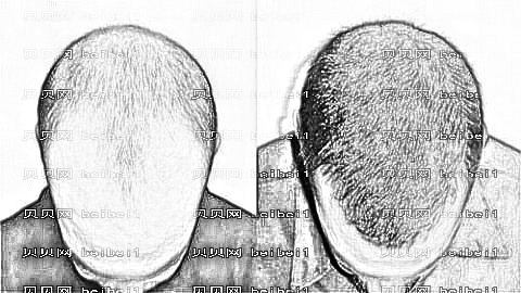 北京薇琳植发怎么样?哪个医生技术好?