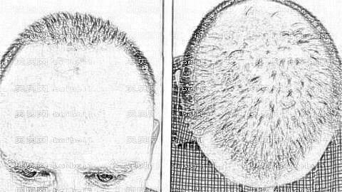 温州新生植发怎么样?哪个医生技术好