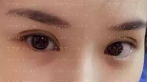 郑州欧华做眼部手术怎么样?郑州欧华做眼部手术手术介绍及