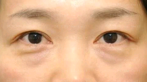郭鑫去眼袋怎么样?郭鑫去眼袋介绍及