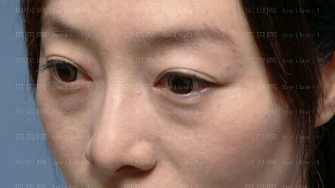 郭鑫去眼袋怎么样?郭鑫去眼袋介绍及