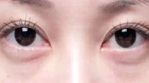 张家口维多利亚去眼袋怎么样?张家口维多利亚去眼袋介绍及