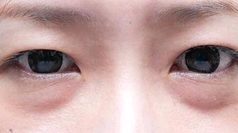 济南韩氏王召东做眼部手术怎么样?济南韩氏王召东做眼部手术介绍及