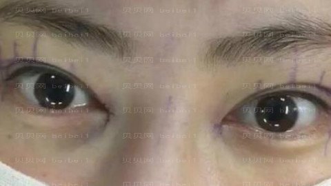 京民医院郭主任做眼部手术怎么样?京民医院郭主任做眼部手术介绍及