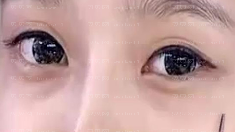 株洲华美医院去眼袋怎么样?株洲华美医院可靠吗?果很不错!