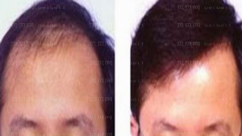 济南熙朵植发怎么样?哪个医生技术好
