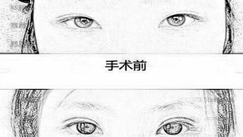 南宁维密整形口碑怎么样?南宁维密双眼皮多少钱?附整形