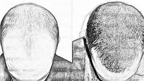 南宁贞韩植发医院靠谱吗?哪个医生发际线植发做得好?附