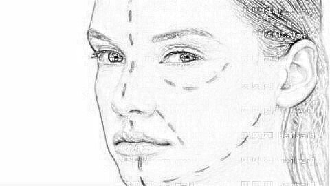 歪鼻子怎么矫正?鼻子歪了矫正需要多少钱?