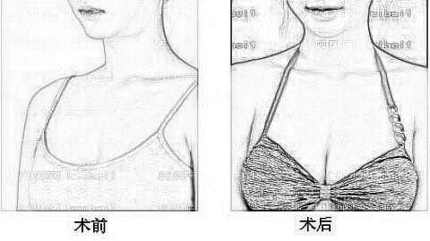 长沙美莱整形医院怎么样?长沙美莱隆胸多少钱?附医生介绍