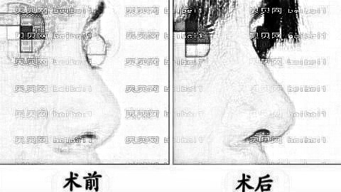 常州美贝尔隆鼻大概多少钱?常州美贝尔整形+医生介绍
