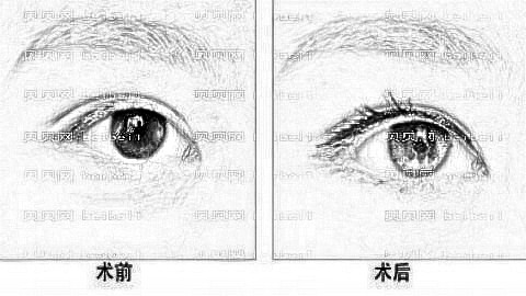 郑颖平医生全切双眼皮技术口碑怎么样?郑颖平双眼皮价格报曝光!