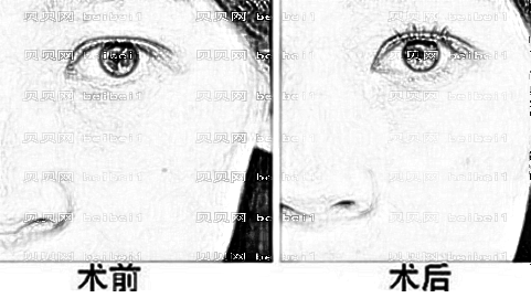 南京美贝尔祛眼袋果好吗?附南京美贝尔,整形价目一览表