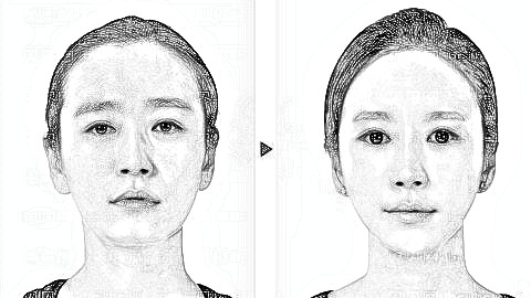 李瑶自体脂肪填充技术如何?李瑶面部自体脂肪填充介绍及