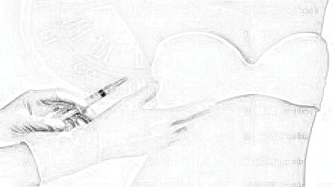复合式隆胸果怎么样?有哪些优缺点?复合式隆胸可以维持多久?