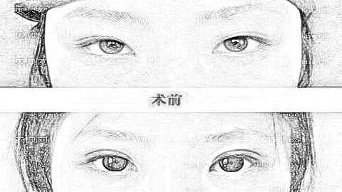 南京医科大学第二附属医院整形靠谱吗？割双眼皮多少钱？附医生排名