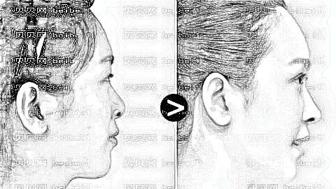 苏州华美隆鼻多少钱？苏州华美隆鼻医生介绍+全新价目一览表
