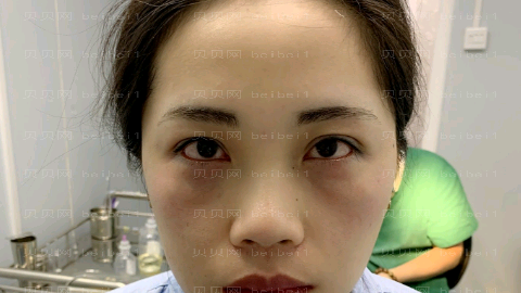 济南爱容整形医院做眼睛怎么样?爱容做眼睛介绍,整形费用明细表流出