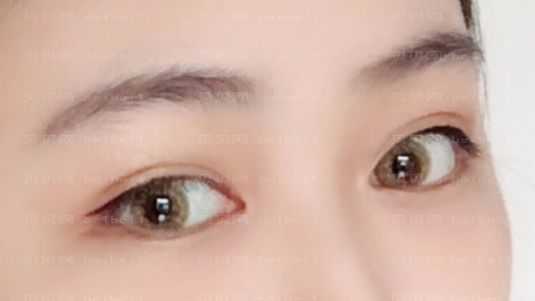 美联臣李燕做眼睛怎么样?美联臣李燕做眼睛介绍及