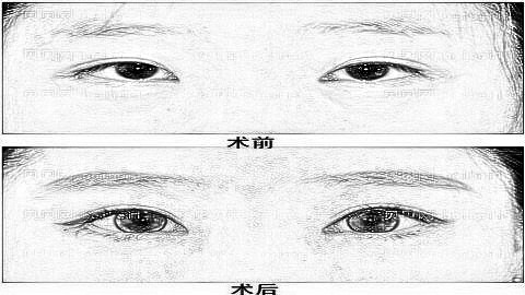 广州双眼皮修复前10专家榜单|附介绍分享+广州双眼皮价格一览表