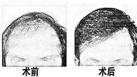 重庆植发好的五大医院介绍单|碧莲盛、新生、雍禾均上榜_