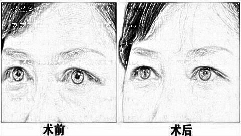 武汉艺龄医疗美容医院正规吗?祛眼袋怎么样?附精选介绍展示