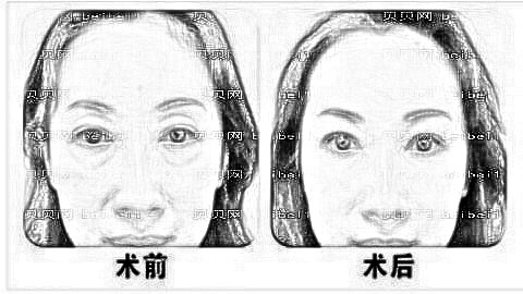 荆州中爱医疗美容医院去眼袋怎么样?附去眼袋介绍+,