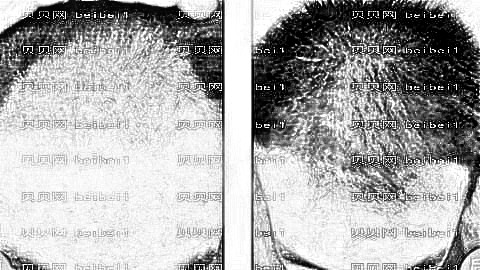 重庆新生植发医院哪个医生技术好?附重庆新生植发医院