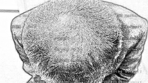 重庆有哪些正规的植发医院?重庆欧亚植发医院怎么样?正规吗?