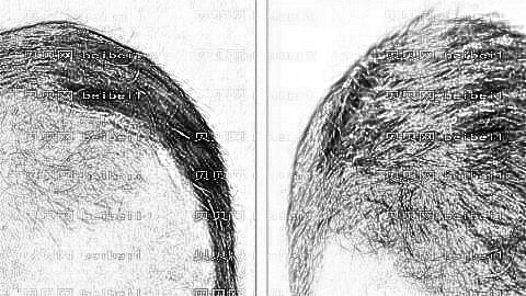 北京植发哪家医院好?多少钱?附北京植发医生排名名单