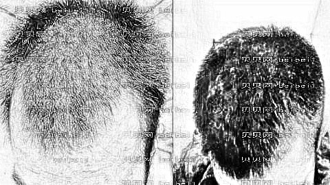 广州植发哪家医院好?多少钱?附广州植发医生排名名单