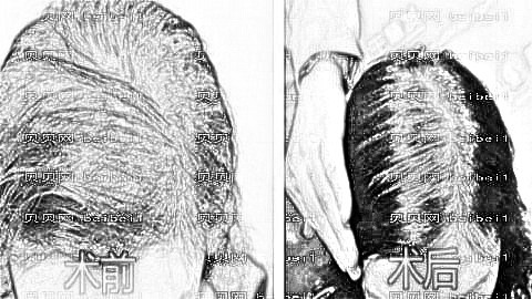 杭州新生植发医院怎么样?附医院地址+医生介绍+新生植发