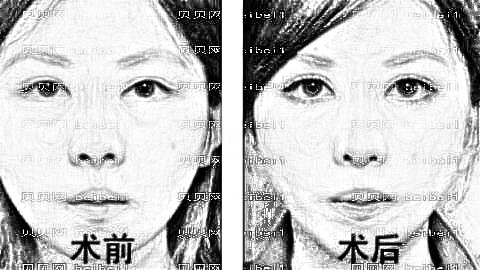 合肥去眼袋哪家医院好?合肥去眼袋医生排名名单&附介绍