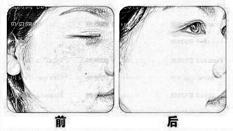惠州祛斑哪家医院好?惠州激光祛斑多少钱?附祛斑介绍