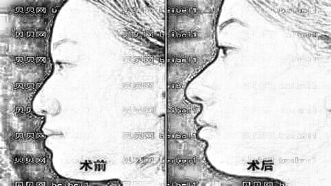 柳州隆鼻哪家医院好?揭秘柳州隆鼻医生排名前五榜单|附介绍
