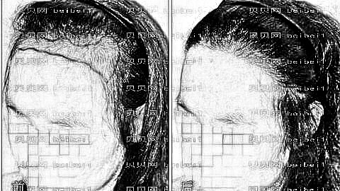 嘉兴植发哪家医院好?多少钱?附嘉兴植发医生排名名单